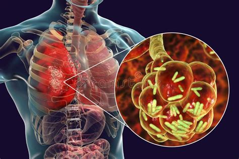 polmoniti batteriche e virali